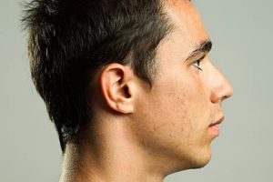 Cofnięta broda, zabieg Derm-Estetyka Gdynia