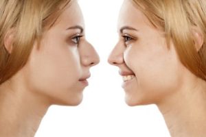 Zabieg korekty nosa w gabinecie Derm-Estetyka w Gdyni.