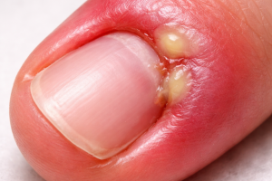 Chirurg paznokcia Gdynia