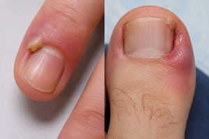 Zanokcica – Derm-Estetyka Gdynia.
