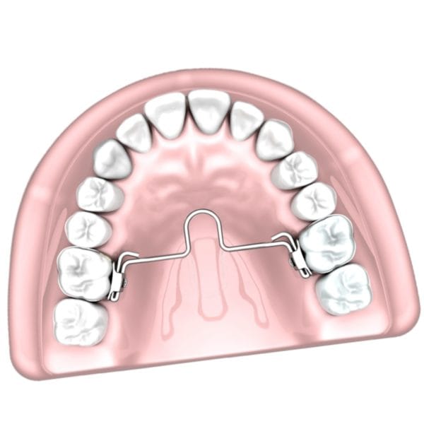 Barras palatinas c/loop mesial 45 a 55 mm - Imagen 2