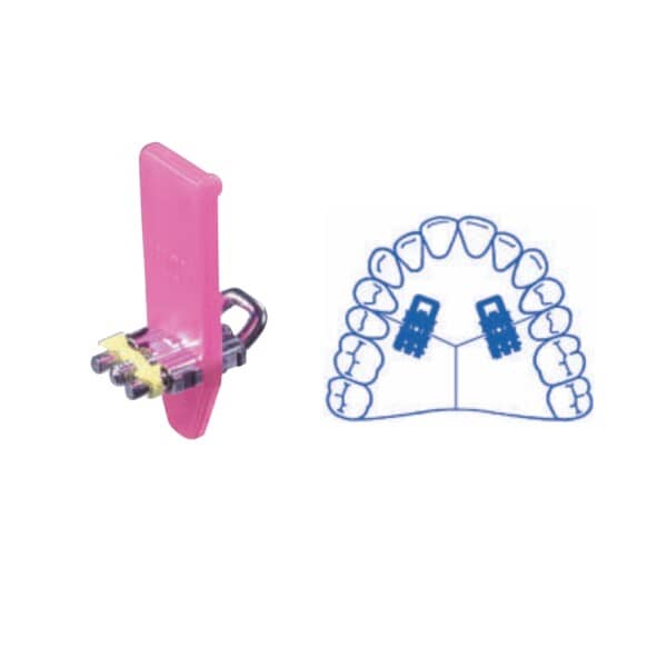 Tornillos de expansión Micro Monolateral con guía en U Doblada