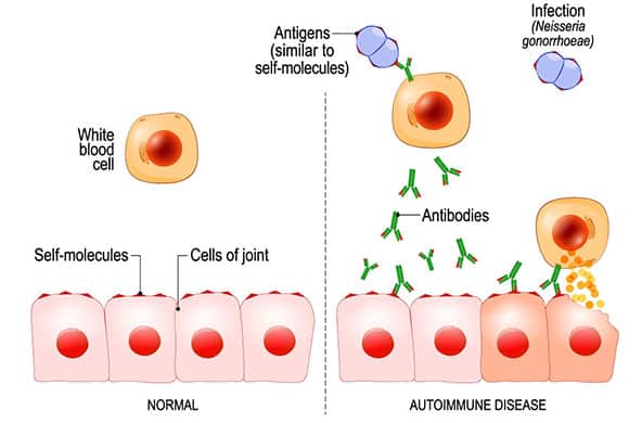 Sanjivani Ayurved Shala therapeutic herbal treatments for autoimmune health support and immune system balance.