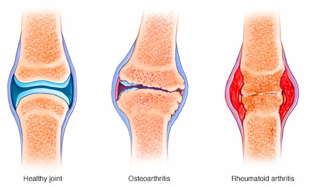 What’s the Ayurvedic treatment approach of Janu Basti for knee issues?