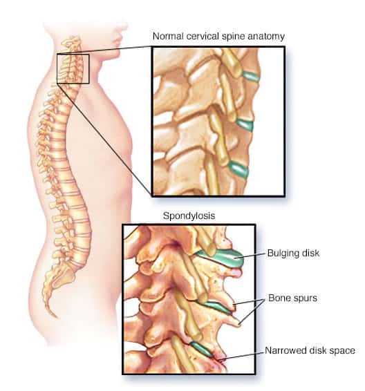 Severe cervical spine illustration highlighting spondylosis, bulging disc, and bone spurs.