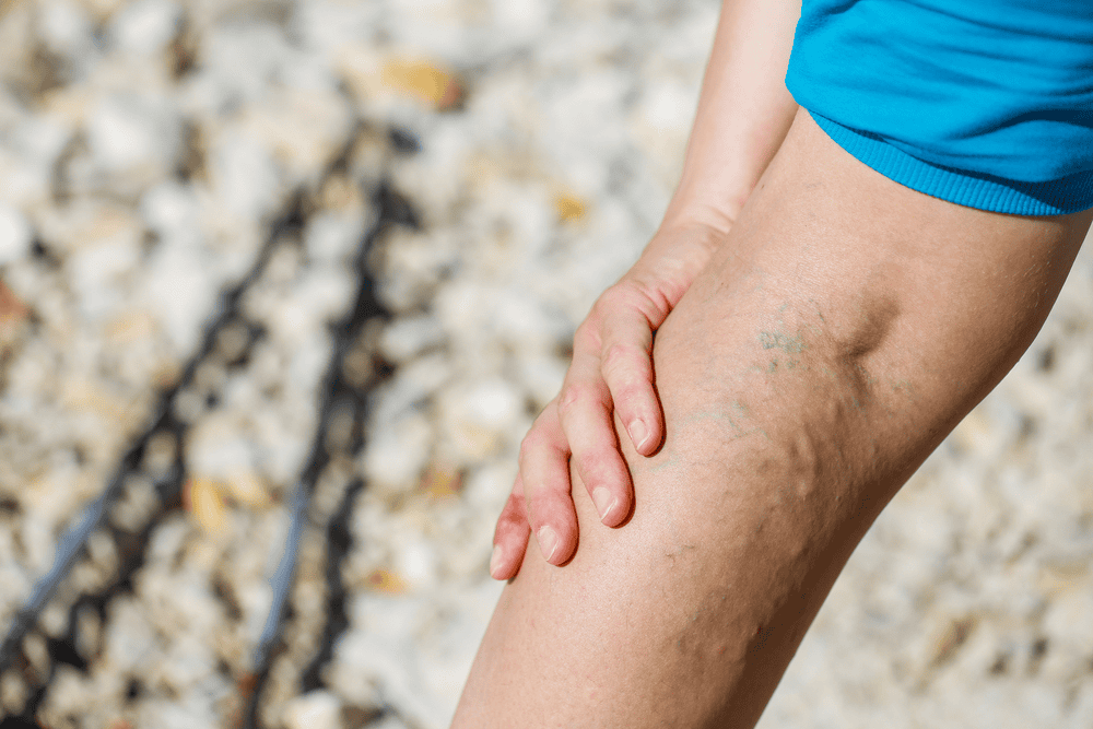 Want To Treat Varicose Veins? Let’s Get Familiar With Its Ayurvedic Treatment
