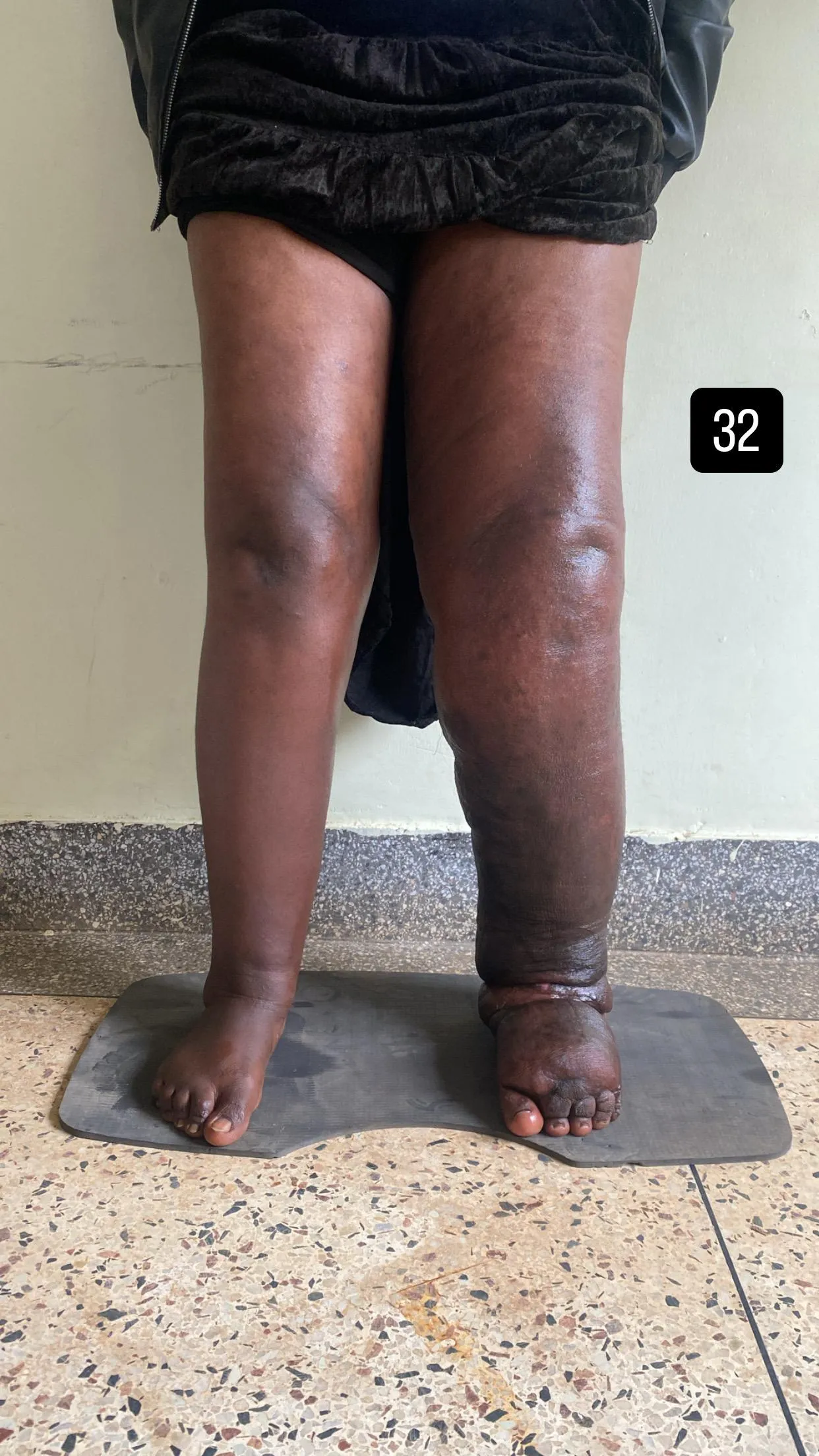 edema-support-foundation-images9