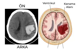 beyin-kanamasi