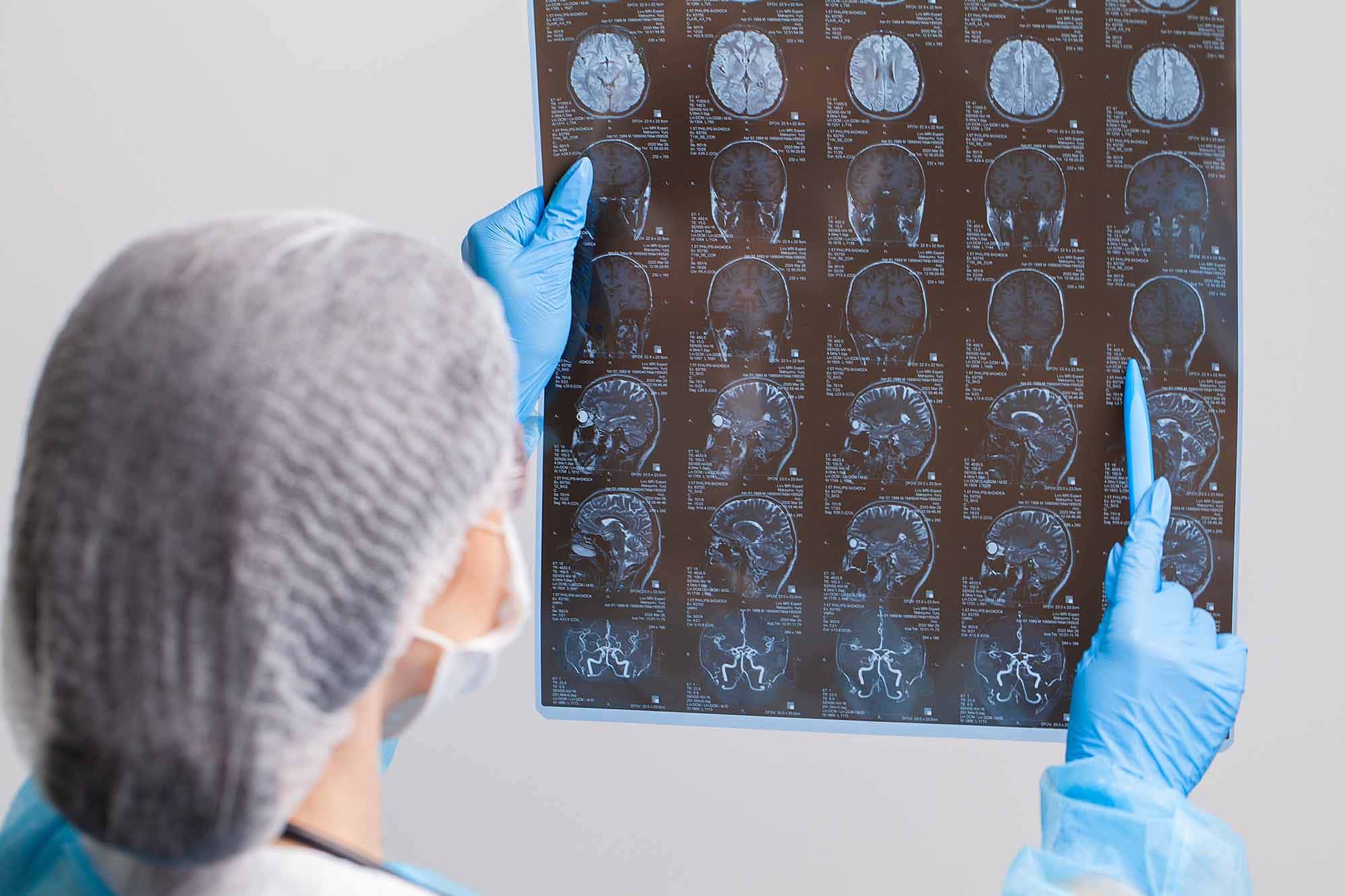 beyin kanaması nedir nasıl tedavi edilir