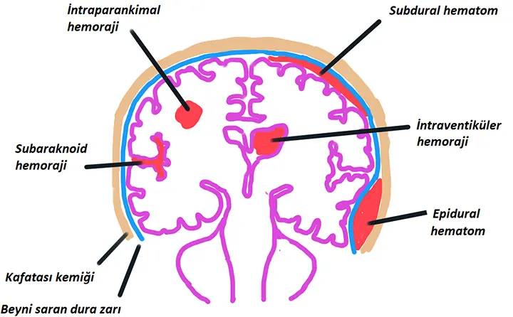 beyin kanaması nasıl oluşur