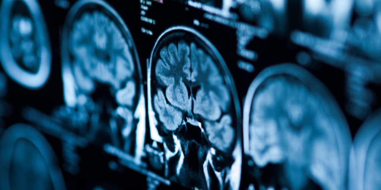 Beyinde Pıhtı Atmasına Ne İyi Gelir?