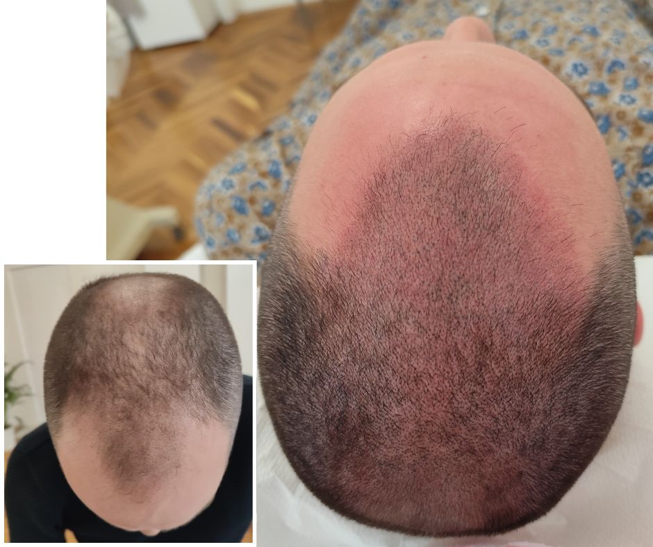 Férfi fejbőrtetoválás hajvonal korrekció