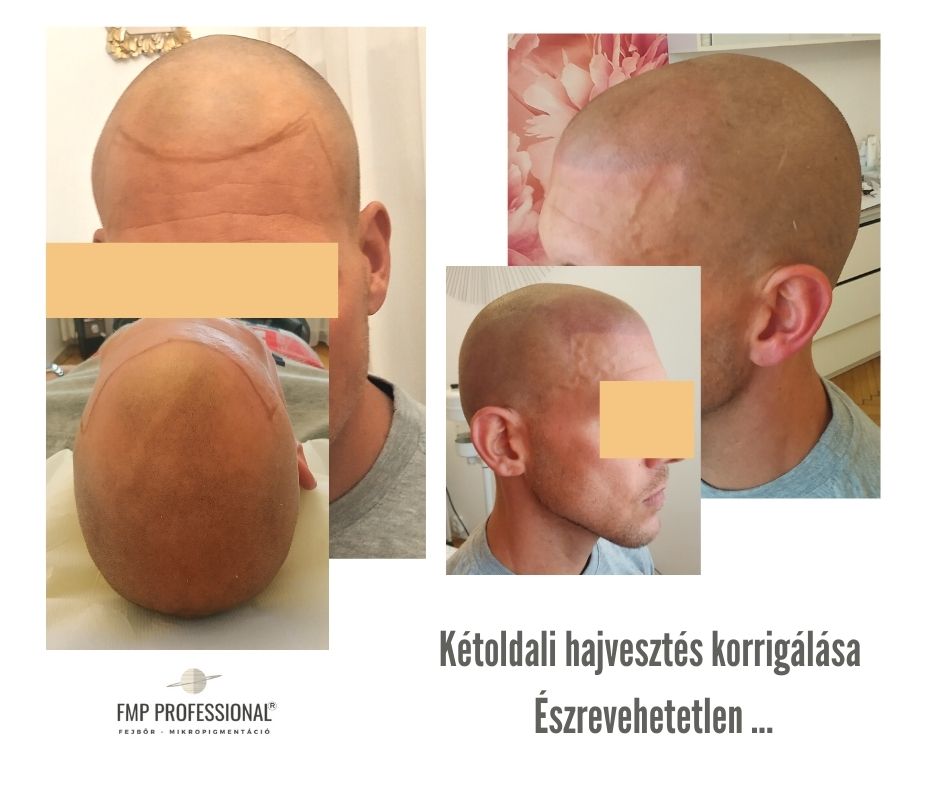 fejbőr-mikropigmentáció elitscalp budapest smp
