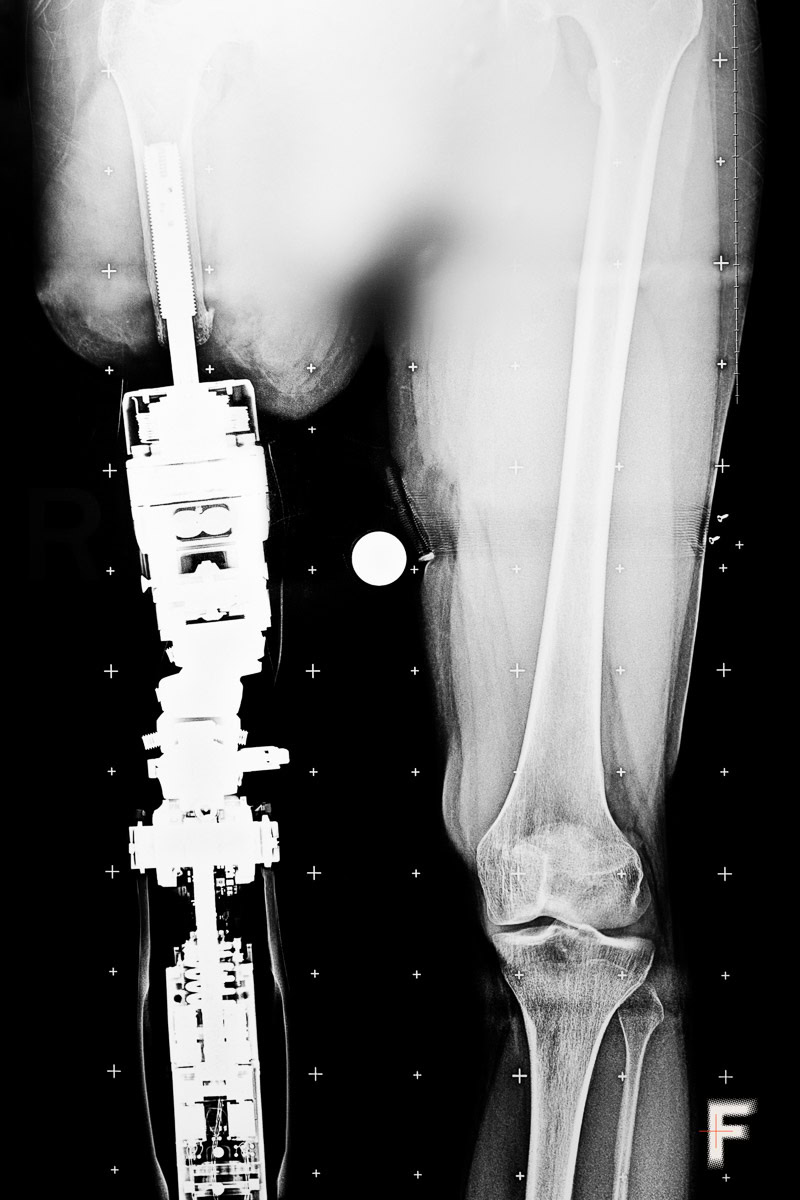 Ghosts of the past – how the brain refuses to let go of lost limbs