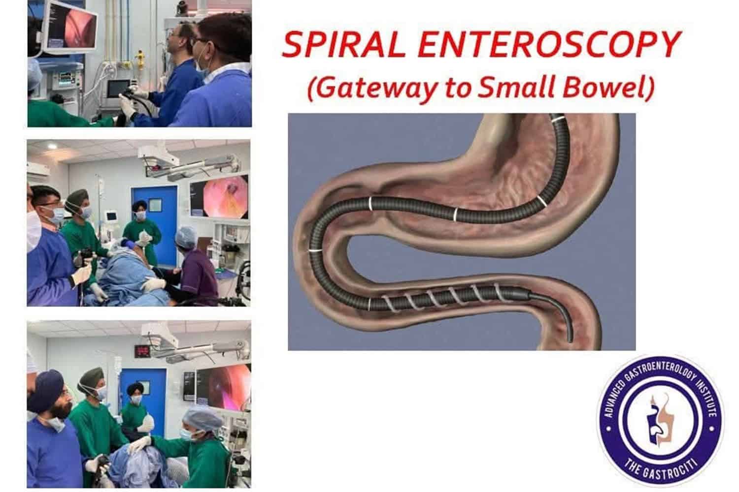 Spiral enteroscopy procedure for small bowel diagnosis at Grover Gastro and Fertility Centre.