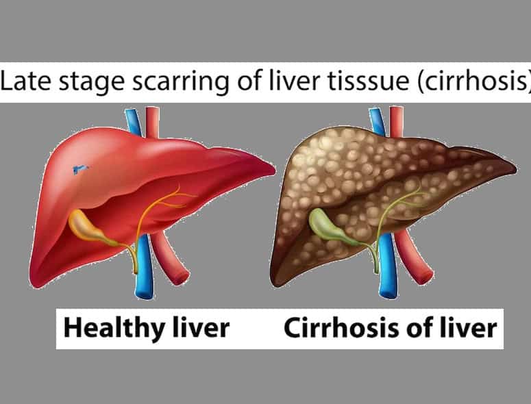Comparison of healthy liver and cirrhotic liver with late-stage scarring.