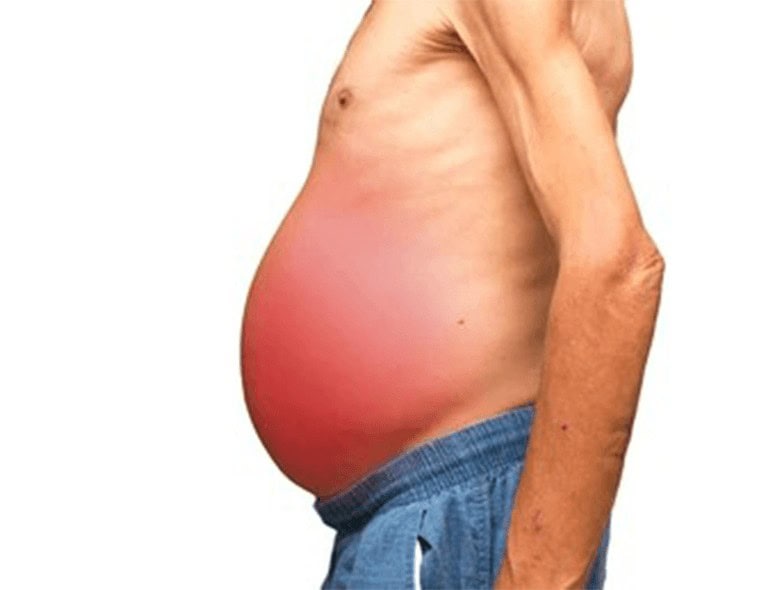Close-up of a person's bloated abdomen showing distension and swelling.