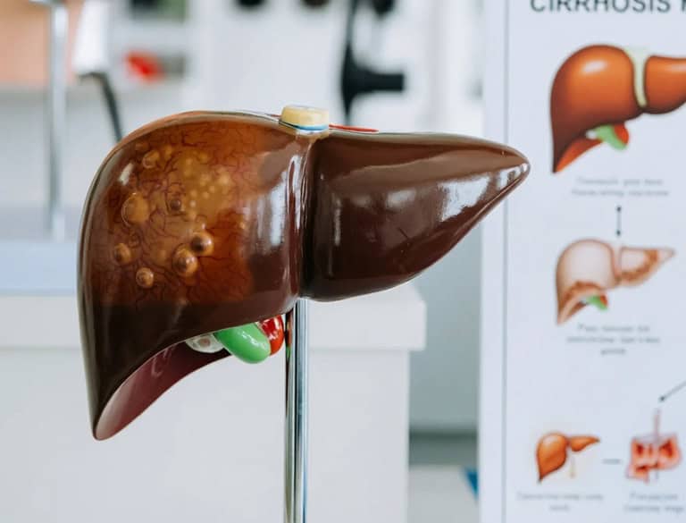 Model of a human liver showing cirrhosis with nodules and scarring.