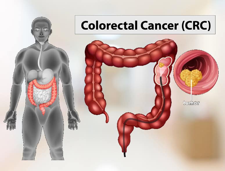 Illustration of colorectal cancer affecting the colon and rectum.