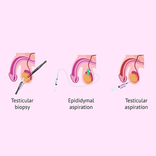 Illustration of testicular biopsy, epididymal aspiration, and testicular aspiration procedures.