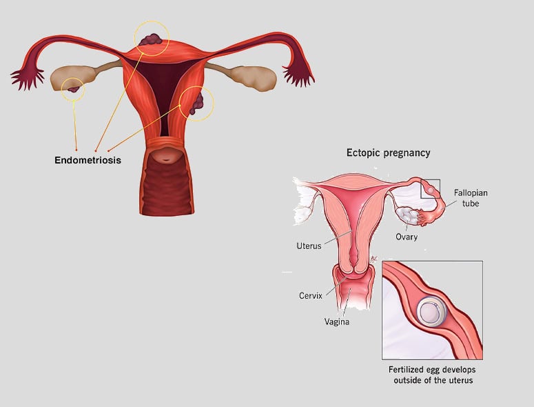 Illustration of endometriosis and ectopic pregnancy in female reproductive system.