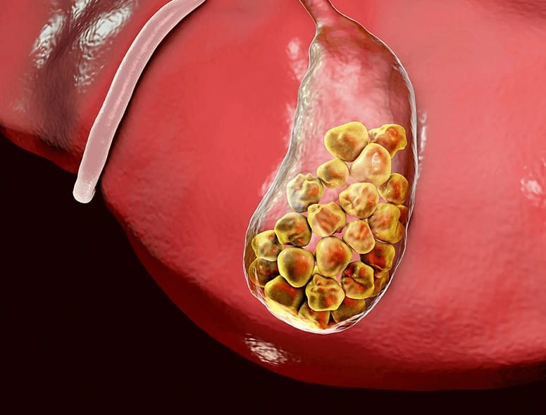 Gallstones in the gallbladder, medical illustration.