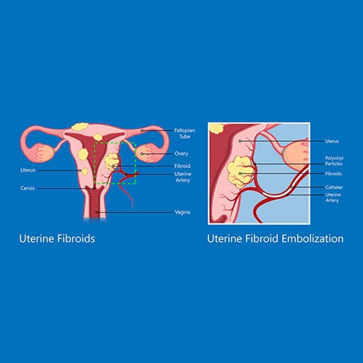 Diagram showing uterine fibroids and fibroid embolization procedure.