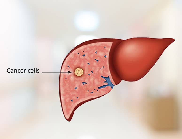 Illustration of a liver with cancer cells inside it.