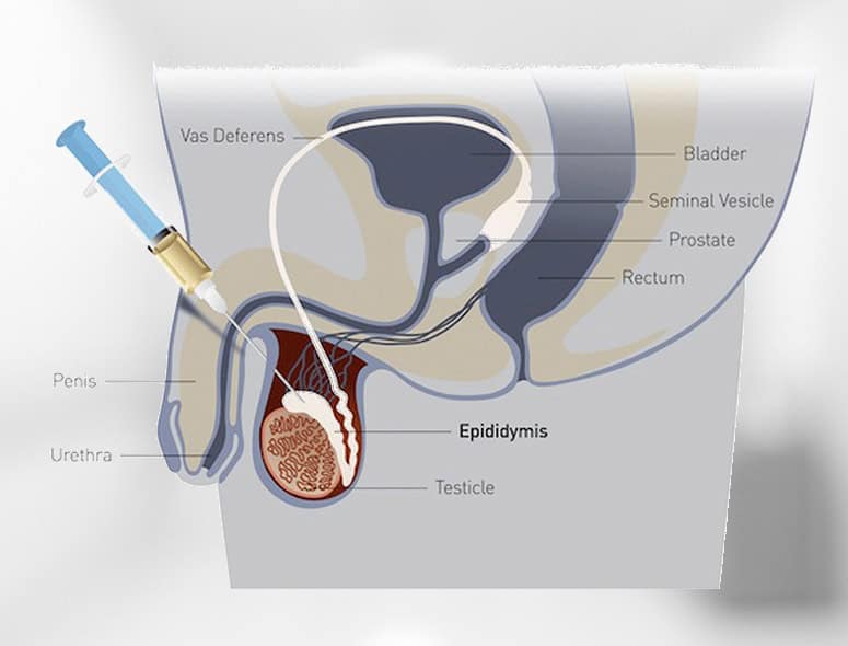 Illustration of male reproductive system with a syringe for medical procedure.