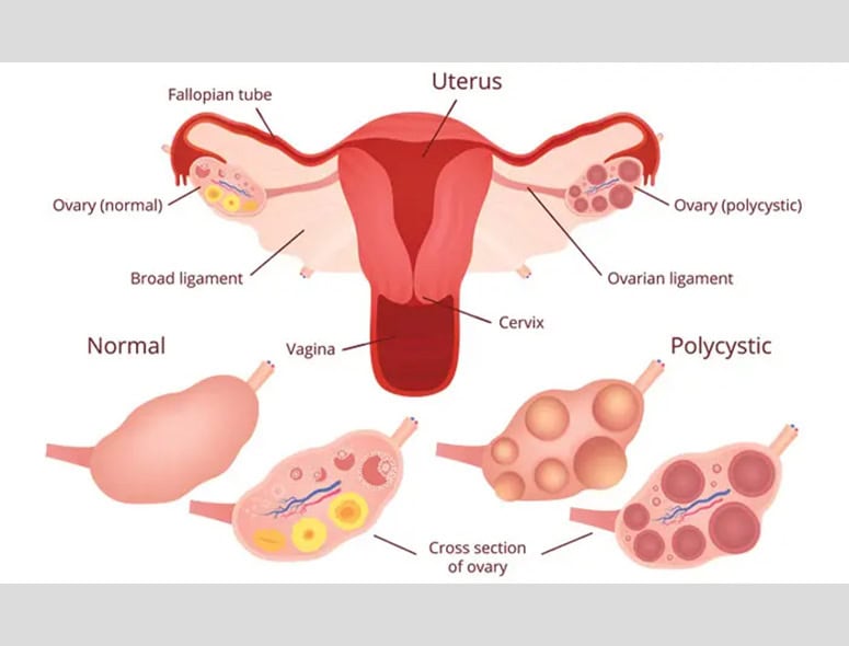 Comparison of normal and polycystic ovaries in female reproductive health.