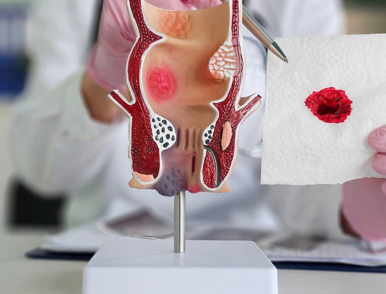 Medical model of the rectum showing hemorrhoids and bleeding.