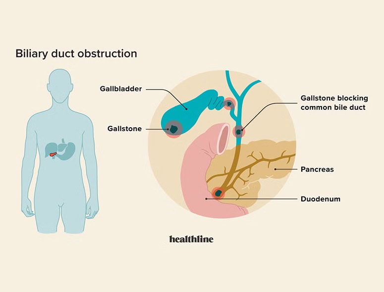 Diagram of gallstone blocking common bile duct and causing biliary duct obstruction.
