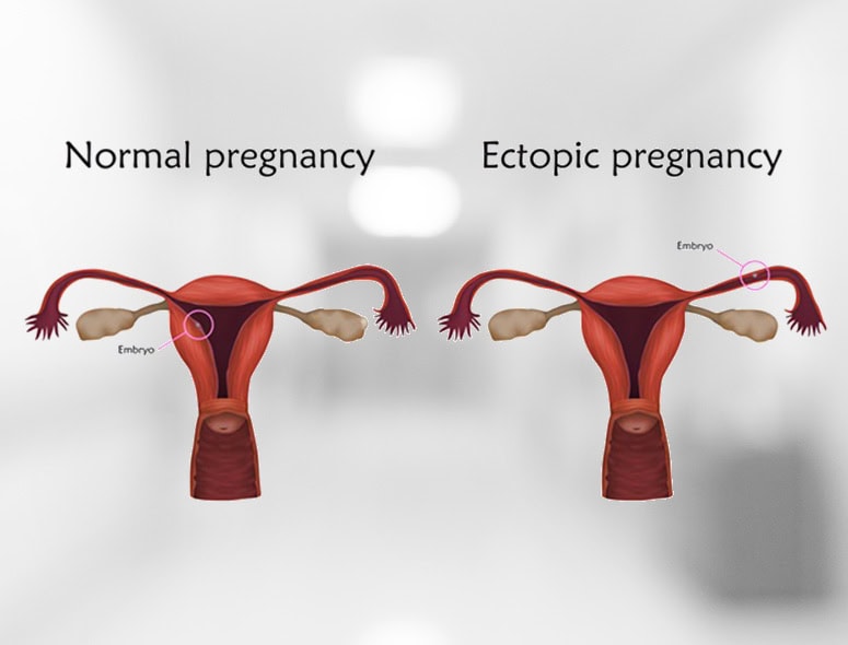 Comparison of normal and ectopic pregnancy in the uterus.