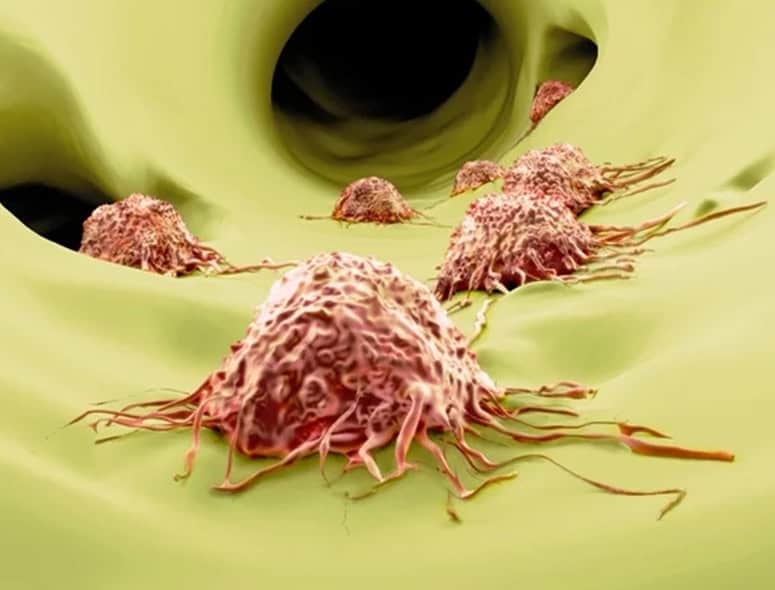 Cancer cells in the esophagus related to esophageal cancer.