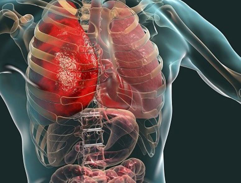 Detailed medical illustration of the human chest showing inflamed pancreas for chronic pancreatitis.