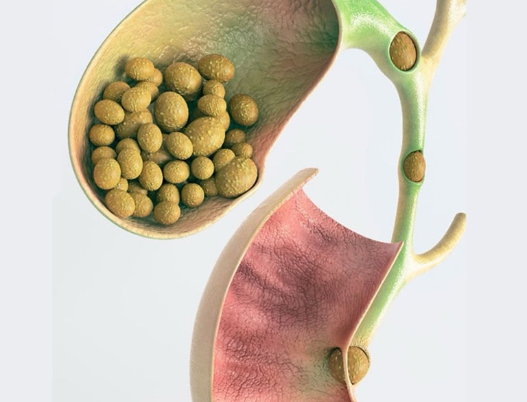 Gallstones in the bile duct causing potential blockages and health issues.