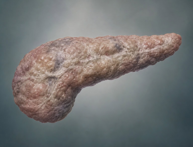 Close-up of a human pancreas showing inflammation or abnormality.