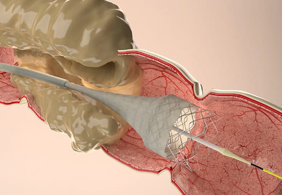 Minimally invasive endoscopic procedure for gastrointestinal treatment.
