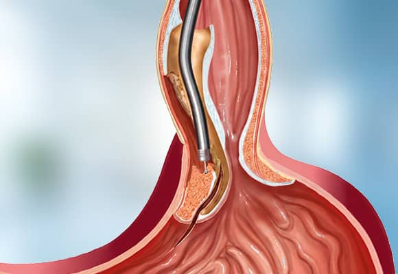 Medical procedure illustration of a colonoscopy for gastrointestinal health.