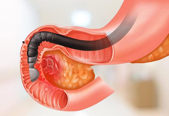 Endoscopic view of the digestive tract with a medical device in place.