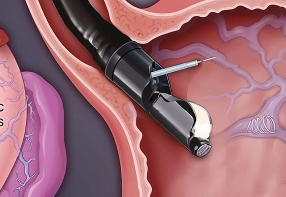 Medical procedure involving a colonoscopy with a flexible tube and camera.