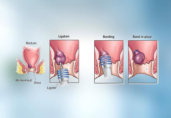 Step-by-step illustration of hemorrhoid banding procedure for treatment.
