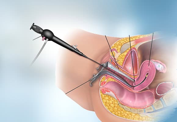 Hysteroscopy procedure for uterine examination and treatment.