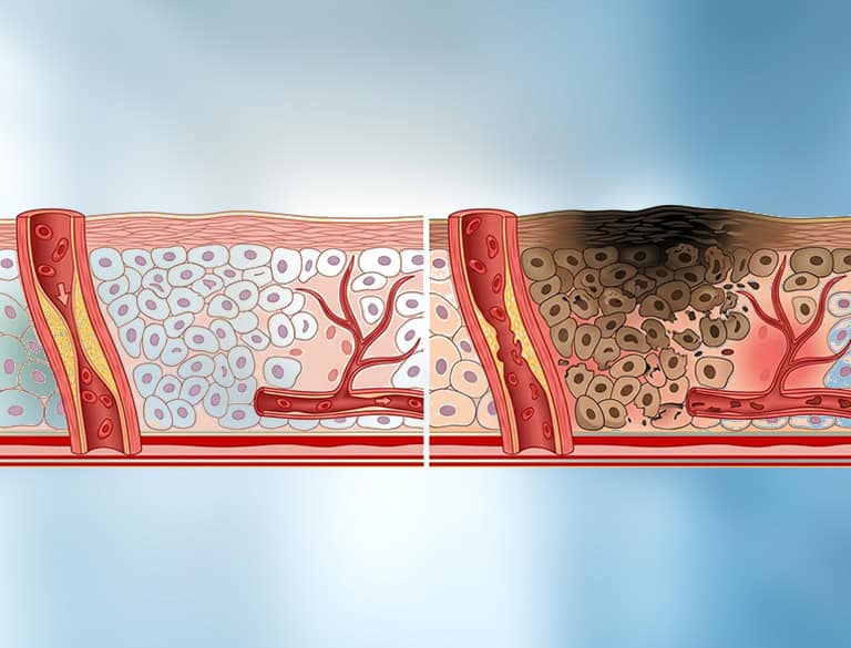 Comparison of healthy and inflamed appendix tissue for acute appendicitis.