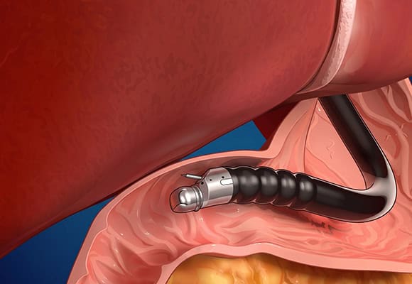 Medical illustration of a prostate exam with a digital rectal probe.