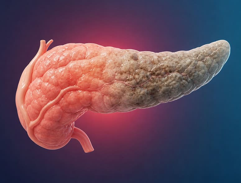 Detailed 3D illustration of the pancreas highlighting inflammation signs.
