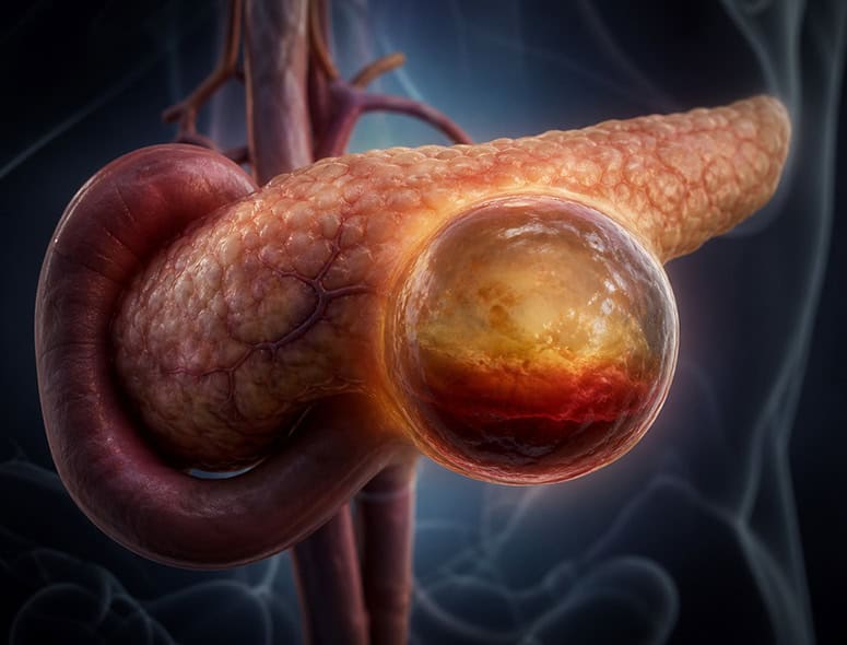 Detailed 3D illustration of the pancreas with a focus on inflammation and cysts.