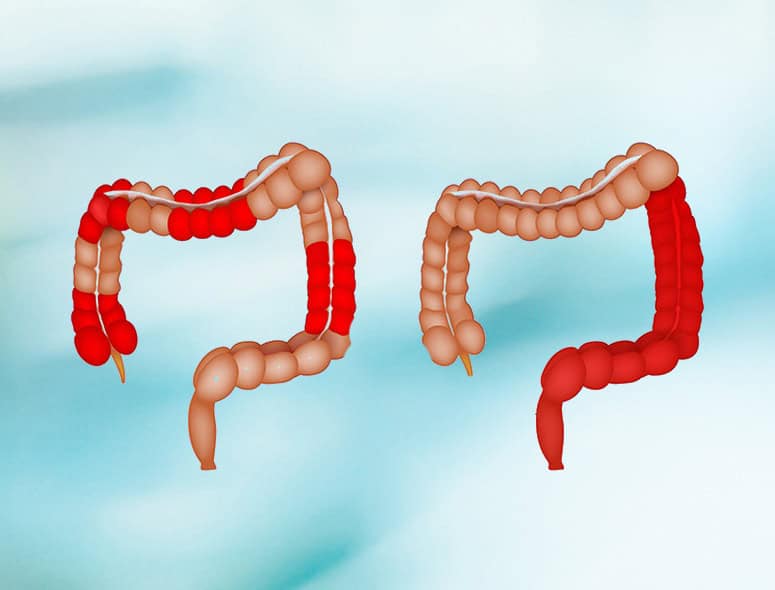 Illustration of inflamed and healthy intestines for Crohn's Disease awareness.