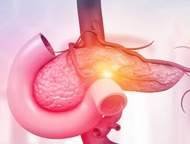 Detailed illustration of the pancreas and surrounding organs with focus on pancreatic cancer.
