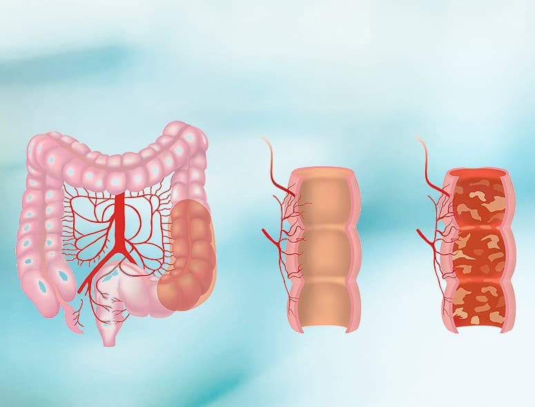 Illustration of healthy and inflamed colon affected by ulcerative colitis.